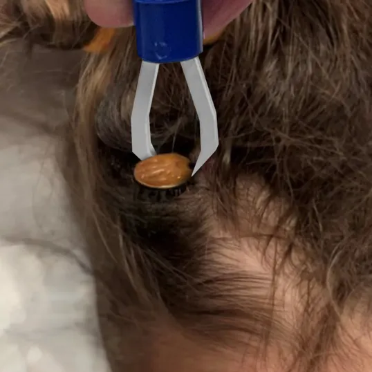 Tick Remover Tool — view 2